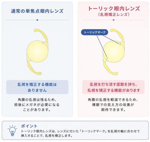 白内障と乱視の関係